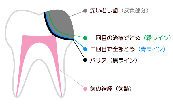 むし歯