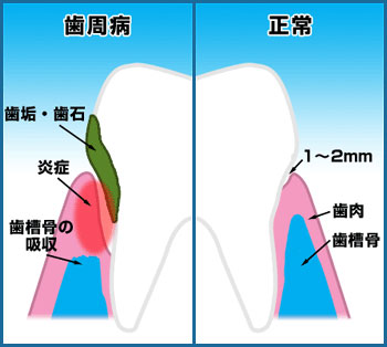 歯周病