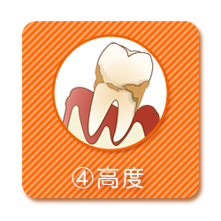 歯周病：高度